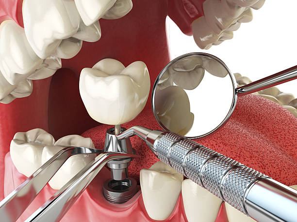 Best Lost Filling or Crown Replacement in Rock Creek, AL